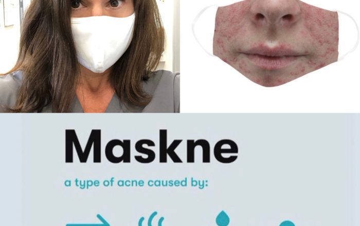 Maskne