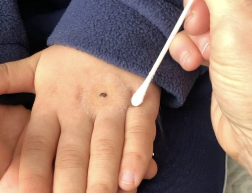 Looking for an Easy Way to Treat Your Child’s Warts?